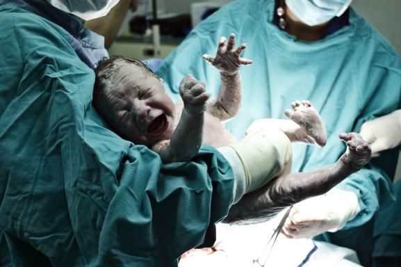 Neugeborenes Baby wird von Ärzten in einem Operationssaal gehalten.